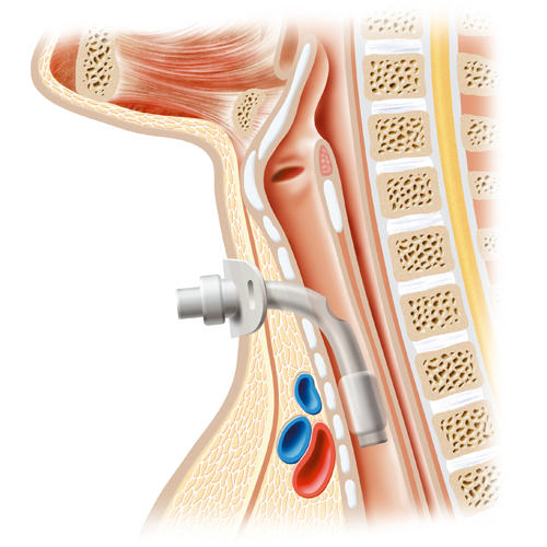Illustration für ein Patientenblatt zum Thema Trachetomie (Perimed Verlag)