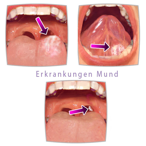 fotorealistische Zeichnungen zum Leukoplakienabstrich, medizinische Illustrationen